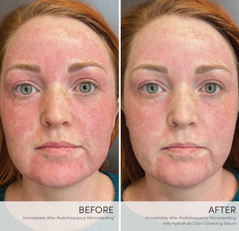 HydroPure™ Color Correcting Serum with Hyaluronic Acid & CoQ10