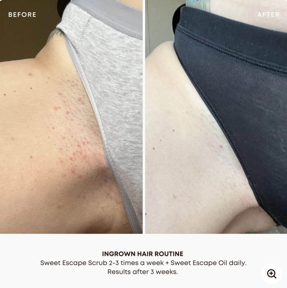 Sweet Escape | Ingrown Hair Oil | Soothes & Softens