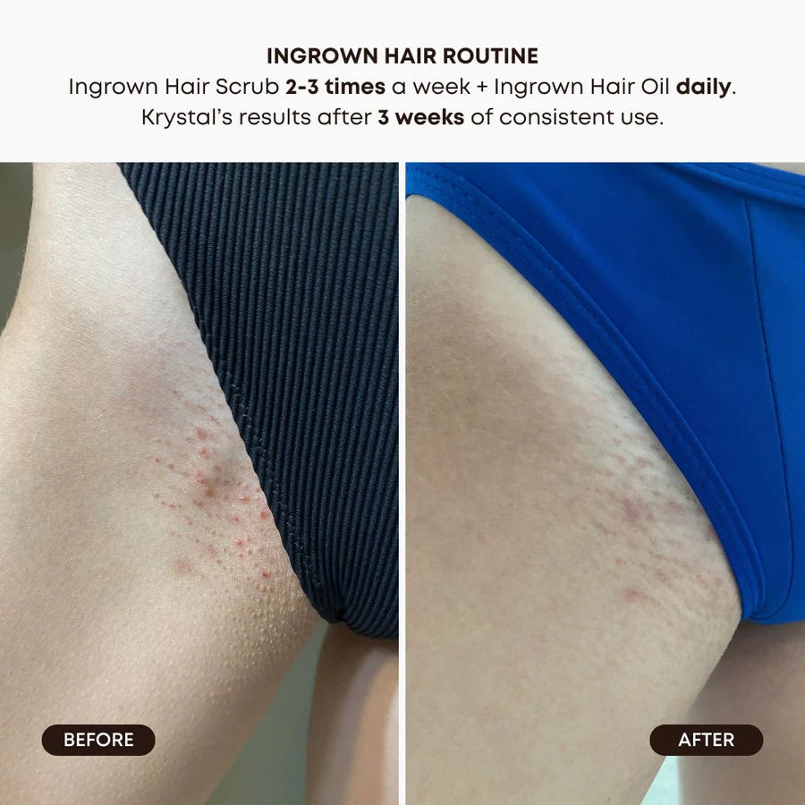 Watermelon Sugar Oil – Reduces Razor Bumps & Irritation After Hair Removal