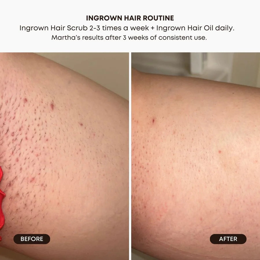 Watermelon Sugar Ingrown Hair Scrub – Exfoliate &amp; Hydrate