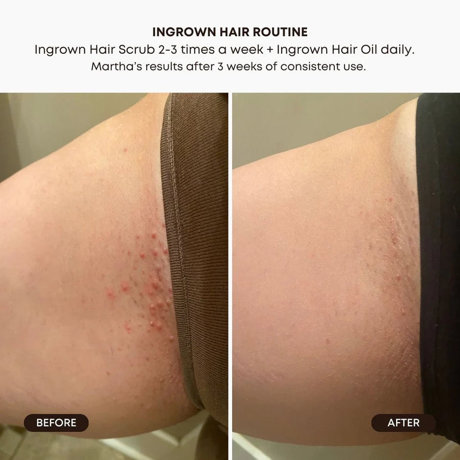 Watermelon Sugar Ingrown Hair Scrub – Exfoliate &amp; Hydrate